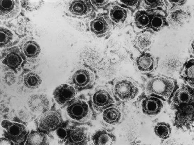 Táo bón là do vi rút… herpes