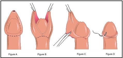 Phương pháp cắt và chăm sóc bao quy đầu sau khi tiến hành làm thủ thuật
